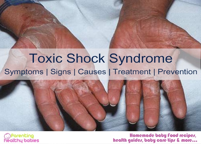 Toxic Shock Syndrome Symptoms Signs Causes Treatment And Prevention