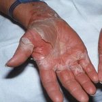 Toxic Shock Syndrome: Symptoms, Signs, Causes, Treatment And Prevention