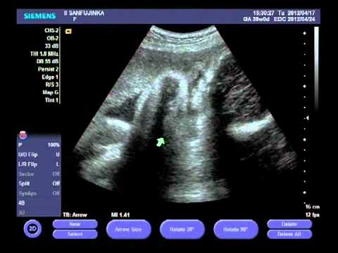 week 39 pregnancy ultrasound