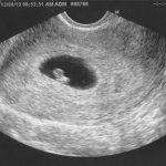 Ultrasound At 6 Weeks – All You Need To Know