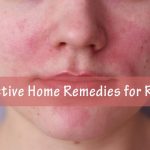 rosacea home remedies