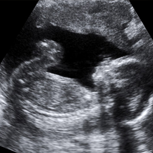 11 Tips to Conquer the Ultrasound Fear