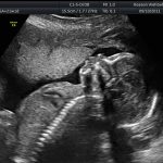 Second Trimester Ultrasound Scans: Everything You Need To Know