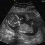 Upt and ultrasound negative, could i still be pregnant?