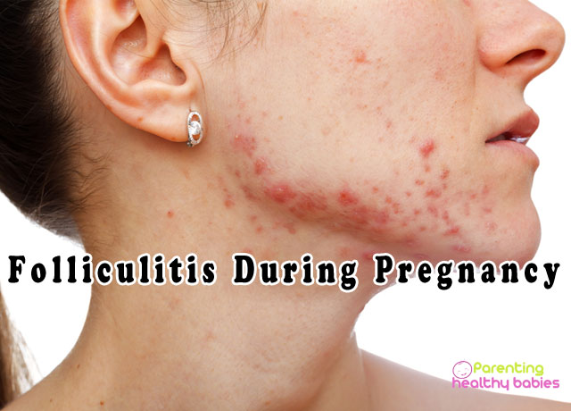 folliculitis during pregnancy