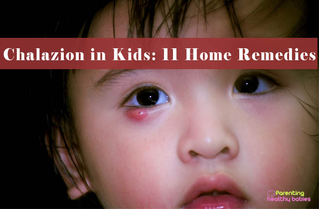 home remedies for chalazion in kids