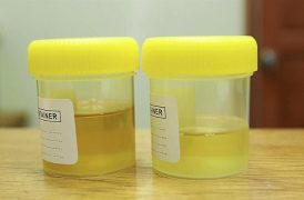 Protein In Urine During Pregnancy: Can It Harm The Baby?