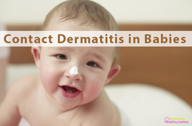 contact dermatitis in babies