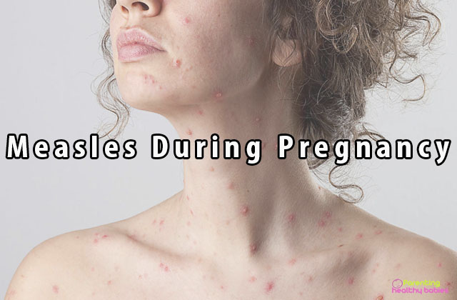 measles during pregnancy