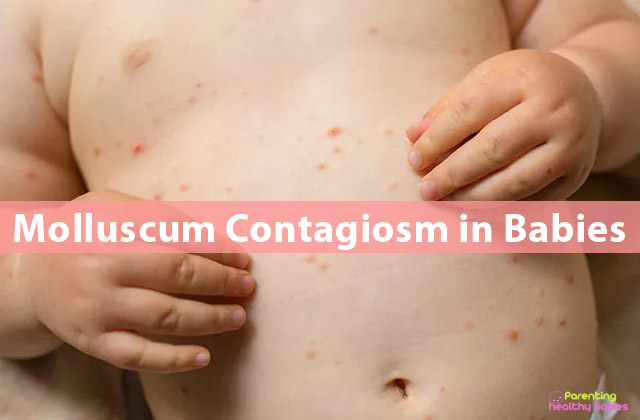 Molluscum contagiosum in Babies: Symptoms, causes and ...