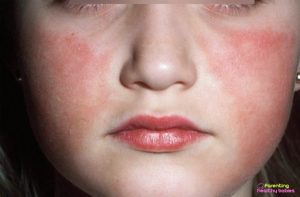 7 Astonishing Symptoms and Cause of Lupus in Kids