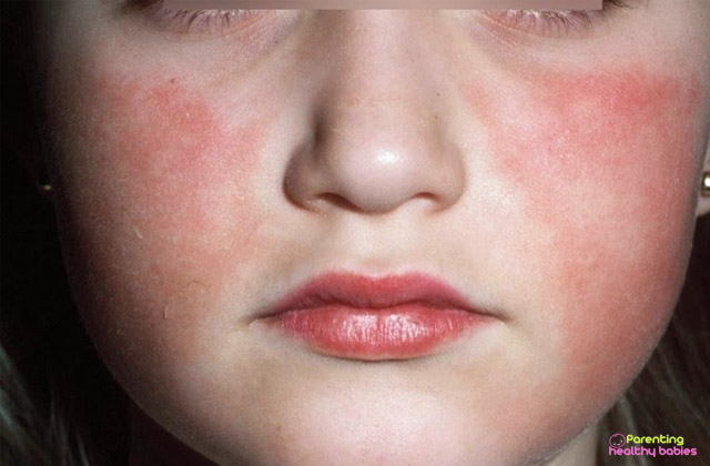 symptoms of lupus in kids