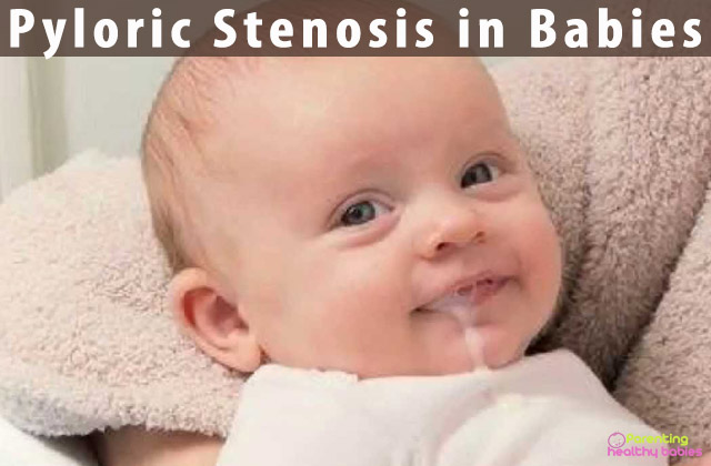 Pyloric Stenosis in Babies