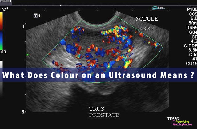 What Does Colour on an Ultrasound Means ?