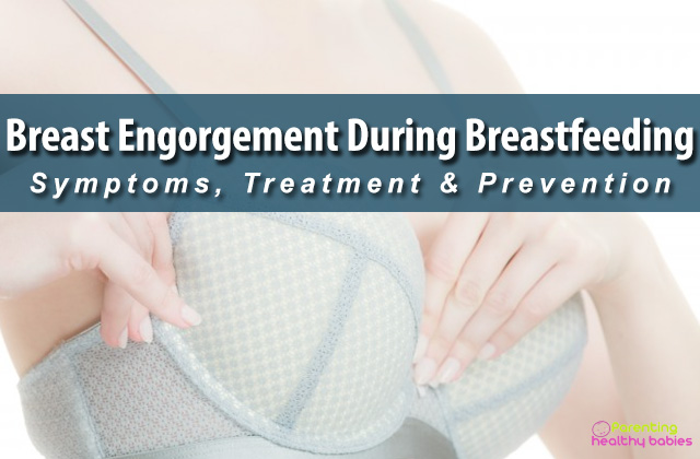 breast engorgement