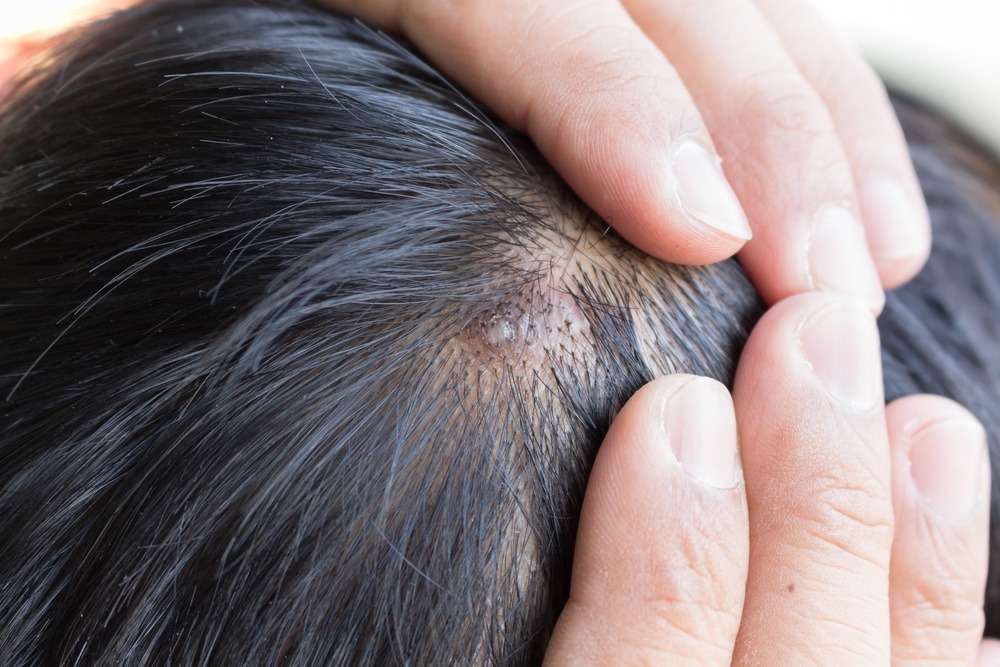 11 Best Home Remedies to Improve Scalp Psoriasis