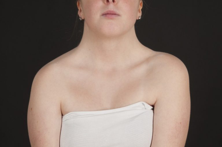 Turner Syndrome and Pregnancy Loss Cause, Symptoms, Diagonsis