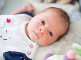 baby acne on face remedies