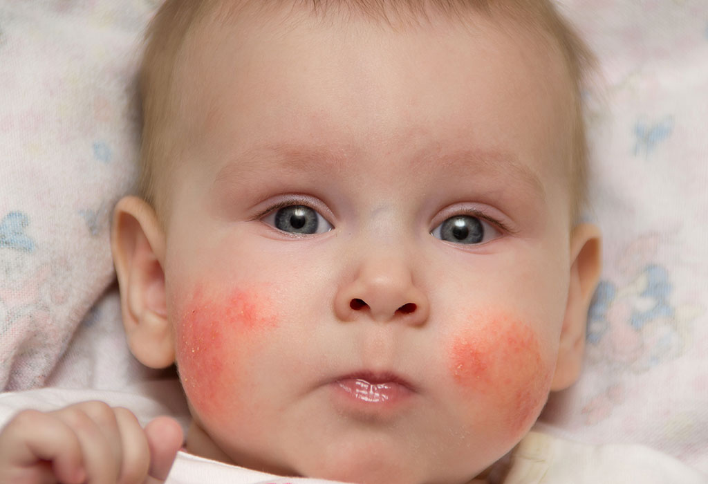 baby acne on face