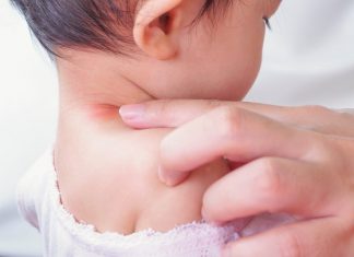 baby neck rash