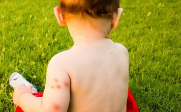 flea bites on babies