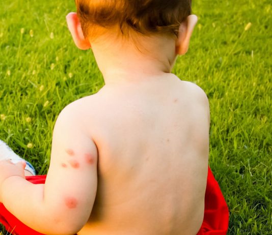 flea bites on babies