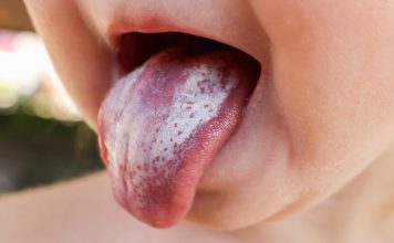oral thrush in babies