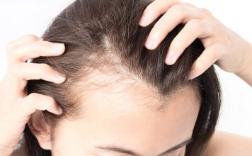 postpartum hair loss