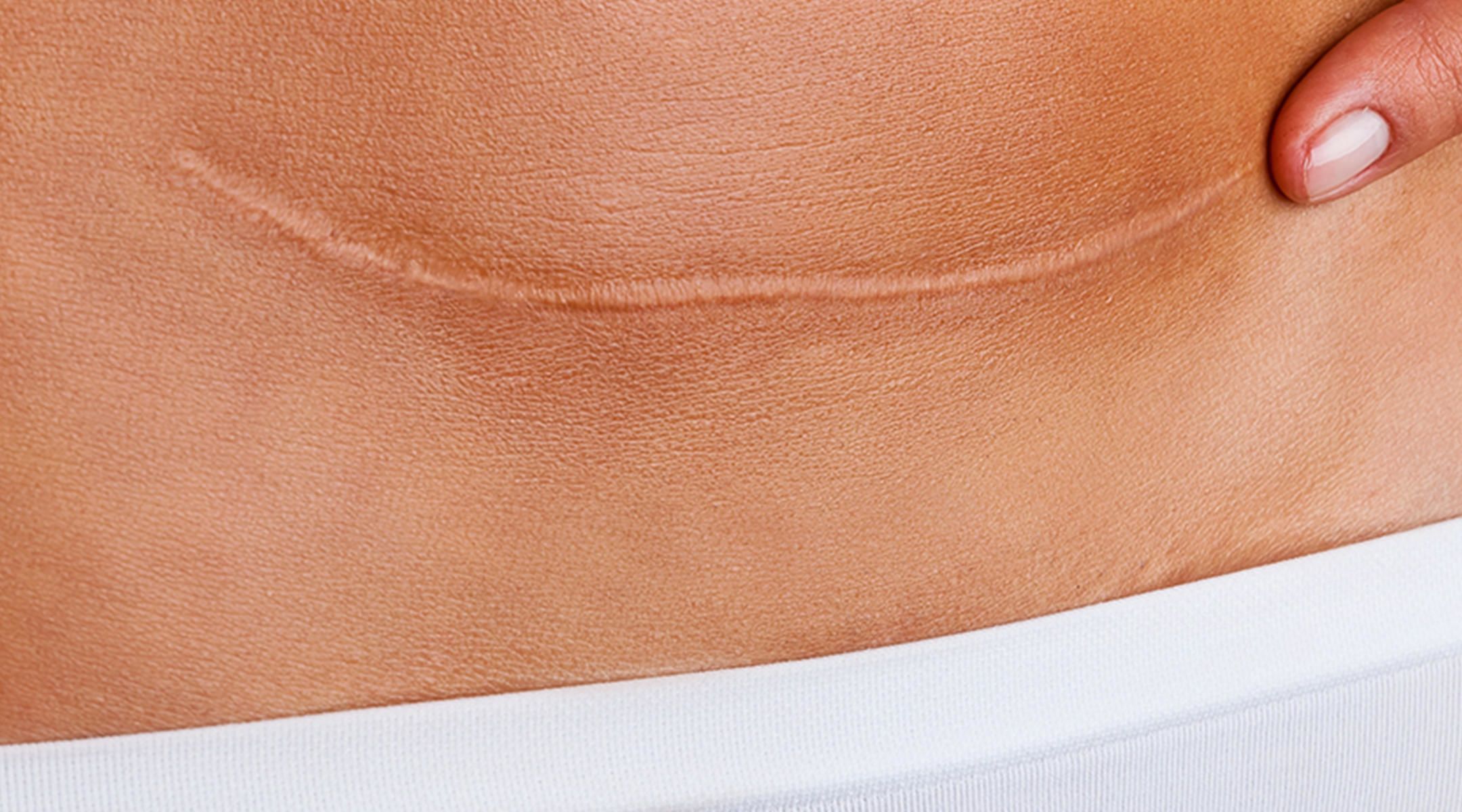 C Section Scar Infection Yeast Infection On A C Section Scar Signs 