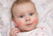 infant rash on face