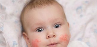 infant rash on face