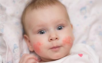 infant rash on face