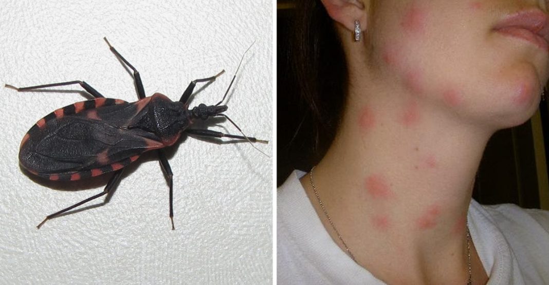 Kissing Bug Bites Can It Kill You Parentinghealthybabies