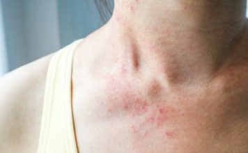 keto rash