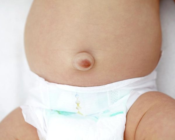 baby-with-umbilical-hernia
