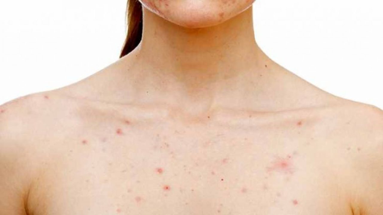 Pimples On Breasts Causes And Home Remedies Parentinghealthybabies