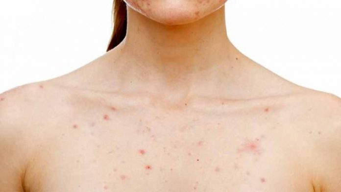 pimples-on-breasts-causes-and-home-remedies-parentinghealthybabies