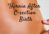 Hernia after C-Section