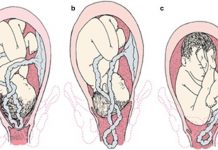 Umbilical Cord Prolapse