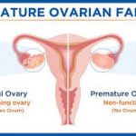 premature ovarian failure