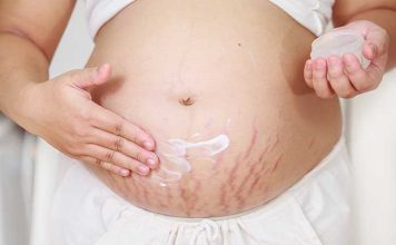 Purple stretch marks: risks and home remedies