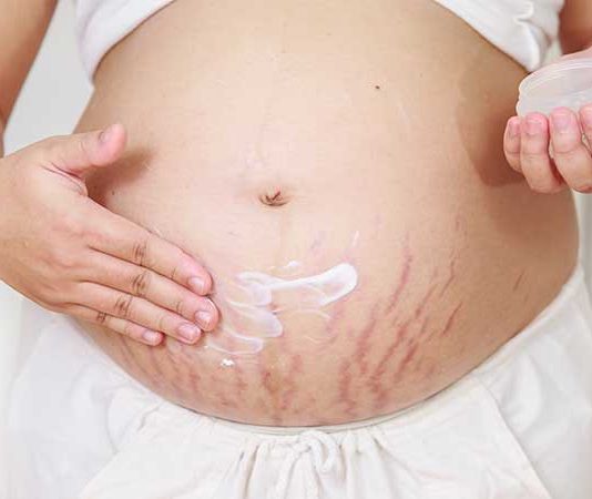Purple stretch marks: risks and home remedies