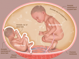 twin-to-twin transfusion syndrome