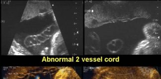 Two Vessel Cord: Causes, Risk Factors and Diagnosis
