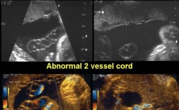 Two Vessel Cord: Causes, Risk Factors and Diagnosis