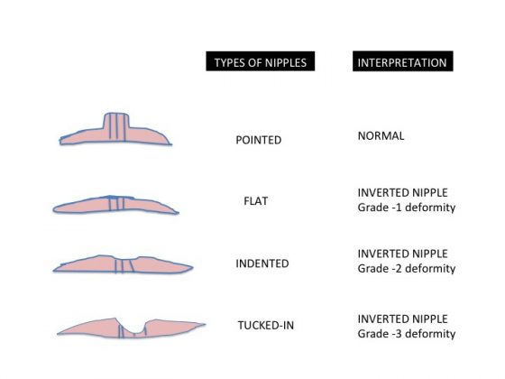 inverted-nipples-causes-treatment-and-breastfeeding-inverted-nipple