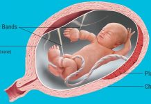 Amniotic Band Syndrome