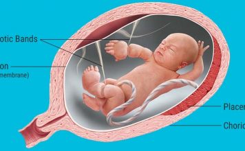 Amniotic Band Syndrome