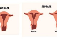 Septate Uterus