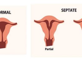 Septate Uterus